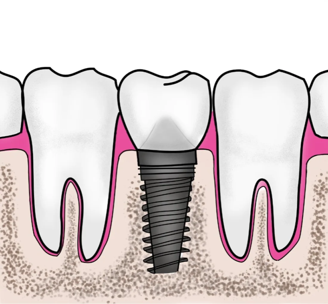 Implants dentaires