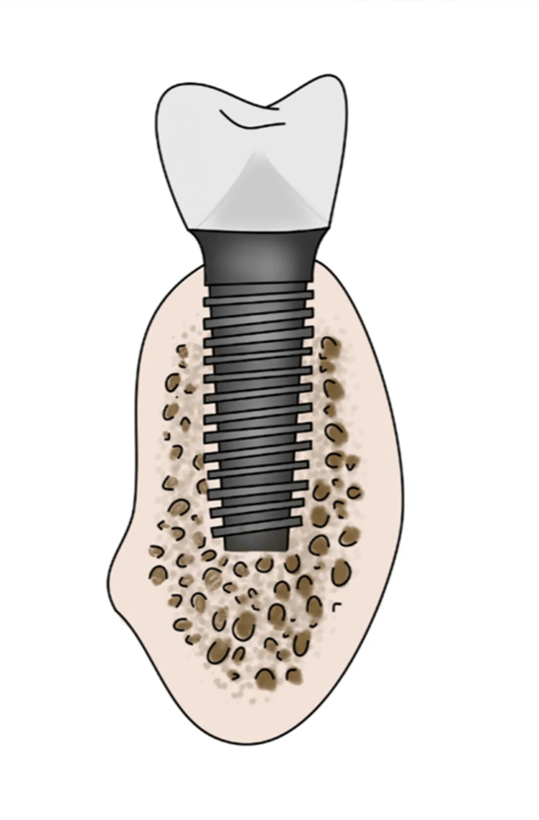 Implants dentaires2