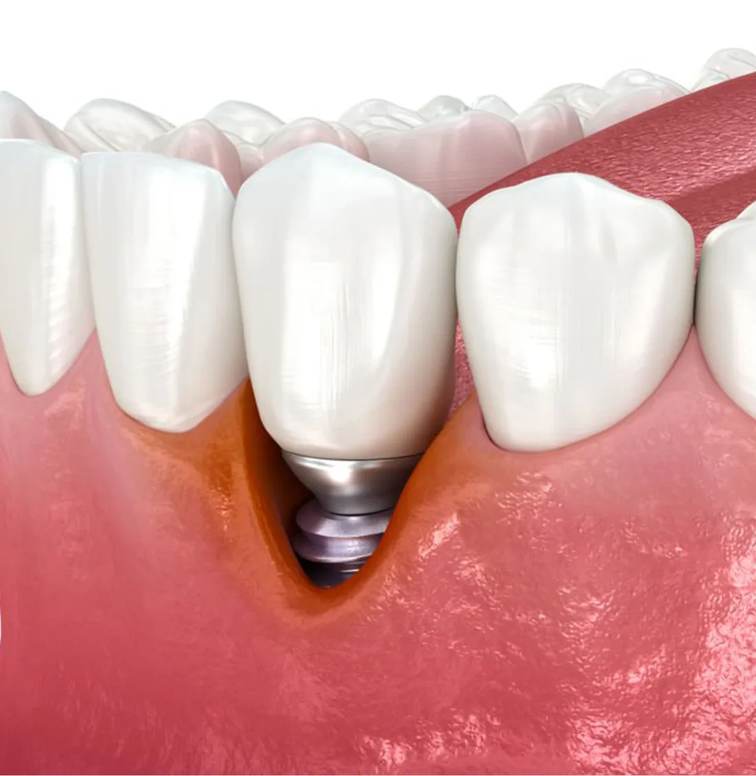 Implant malade