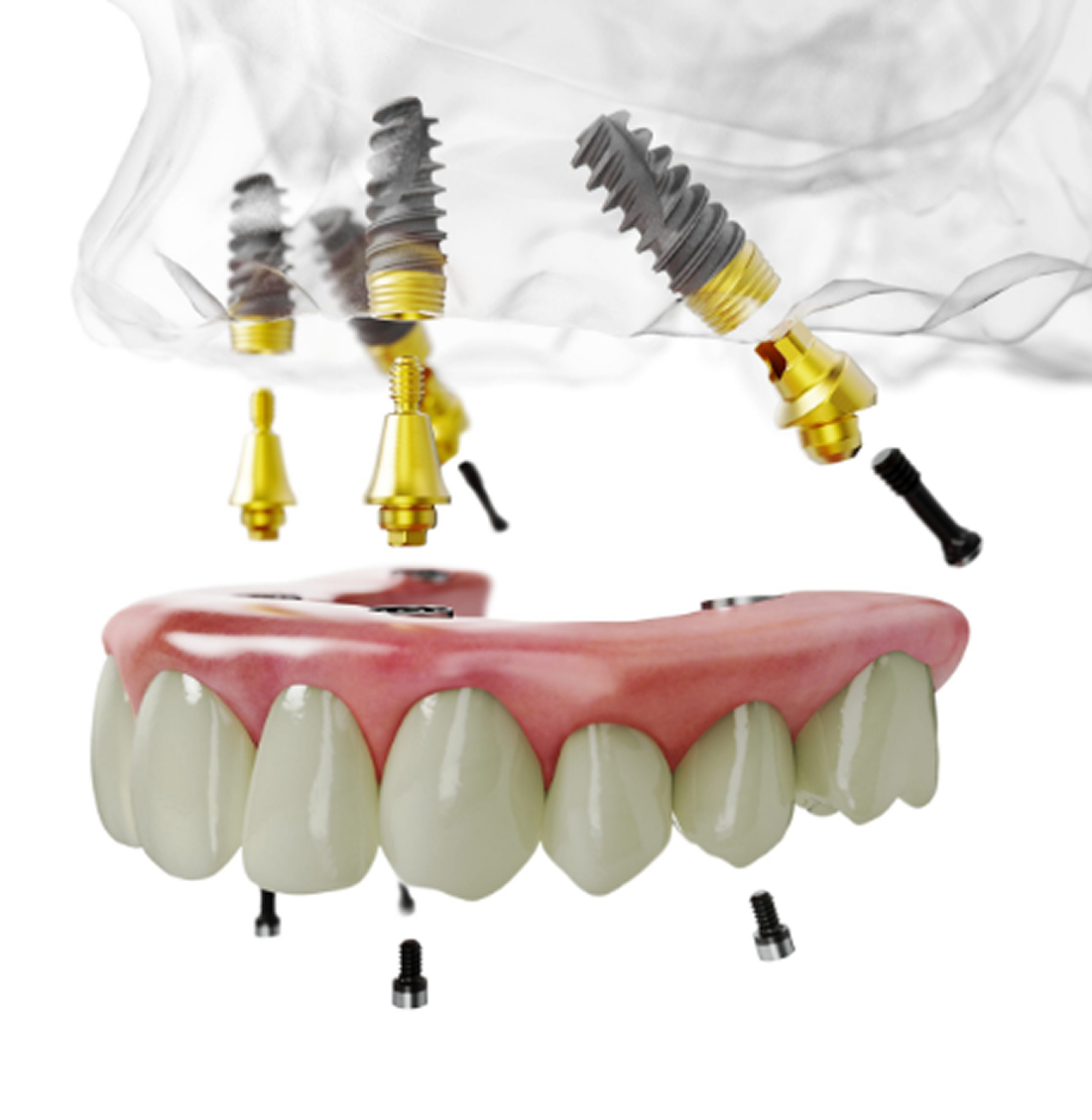 Implant solution