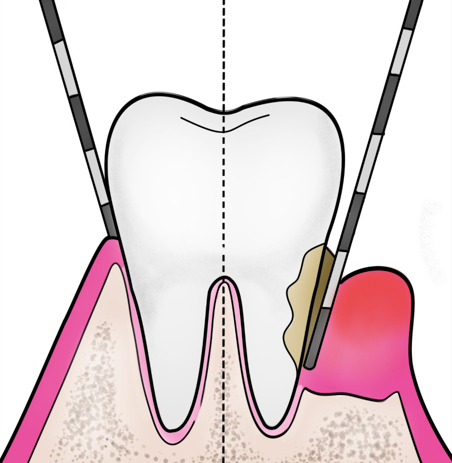 Traitement-de-la-parodontite1