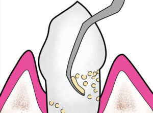 Traitement-de-la-parodontite2