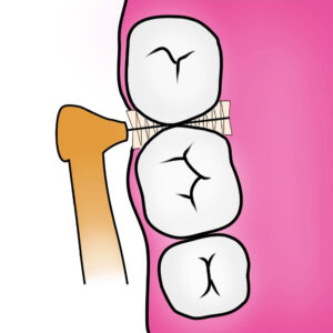 Traitement-de-la-parodontite5
